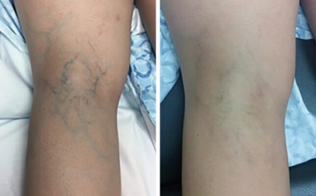 Sclerotherapy_1