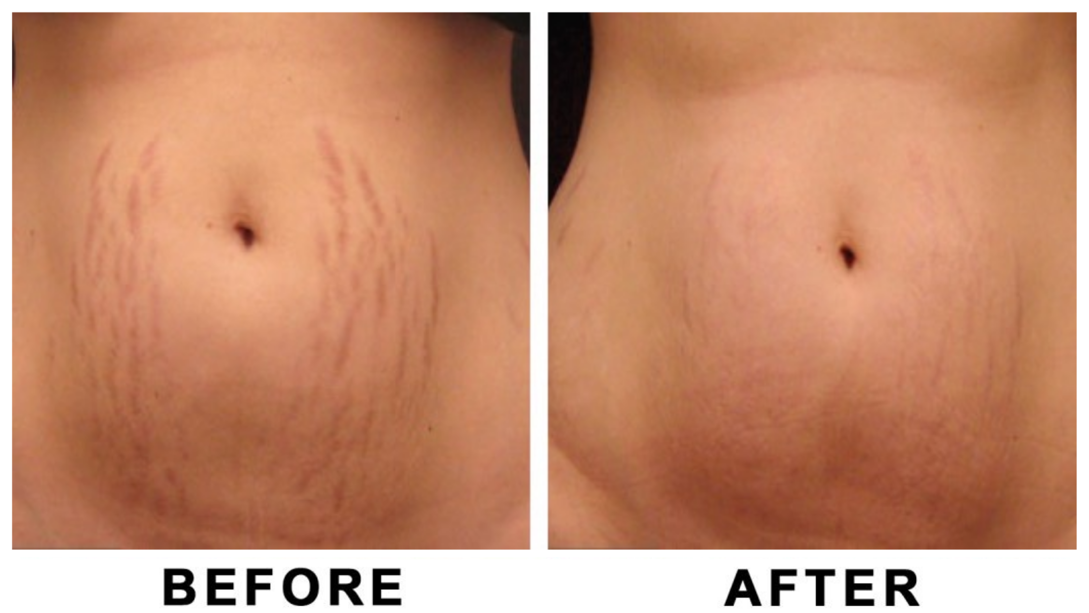 PRF Treatments Before and After