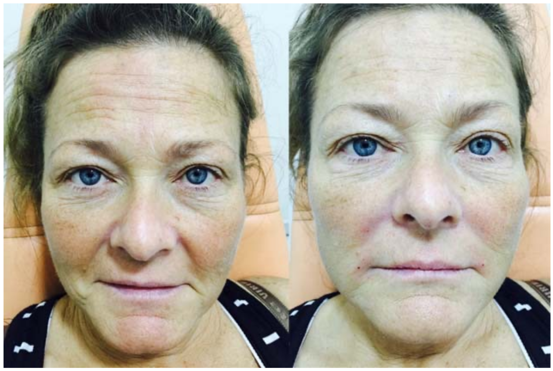 PRF Treatment Before and After Picture